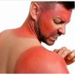 Llama IMSS Nayarit a prevenir quemaduras solares en temporada de calor