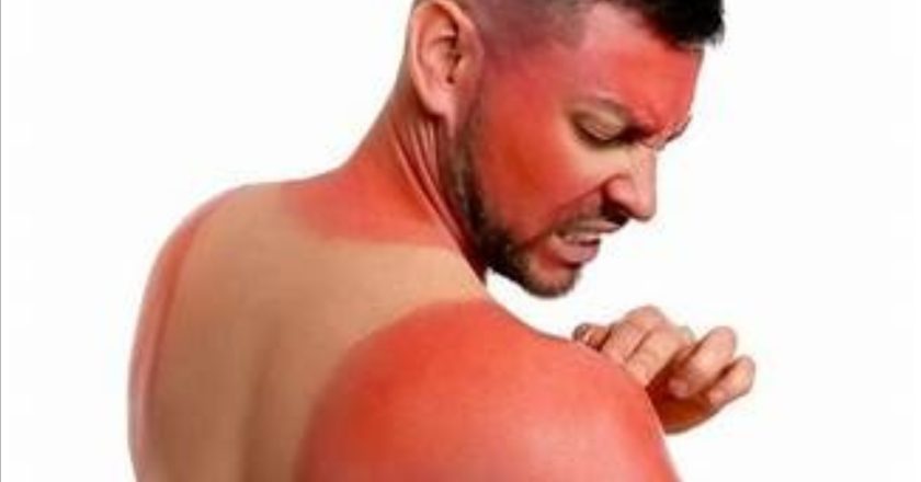Llama IMSS Nayarit a prevenir quemaduras solares en temporada de calor